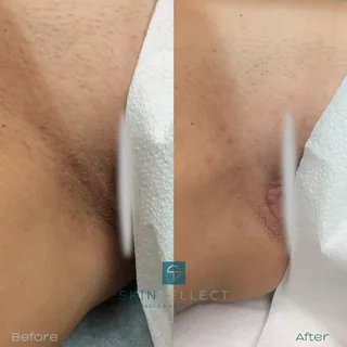 Anal Whitening Results: Before & After Visuals